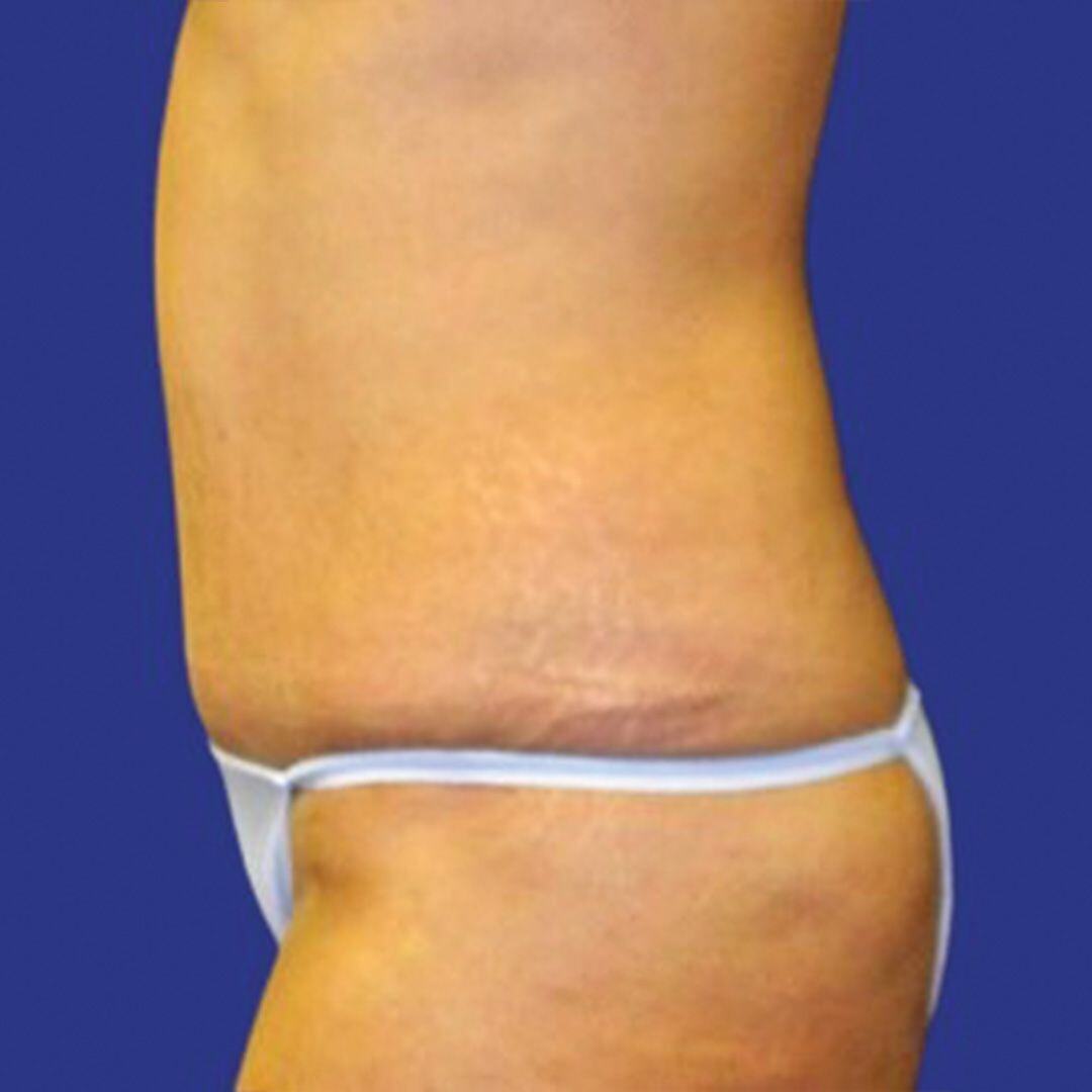 Achieve Your Dream Body with Our Tummy Tuck Surgery Solutions